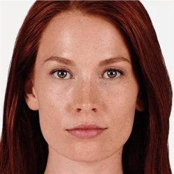 JUVÉDERM® VOLUMA® XC Before & After Patient #1652